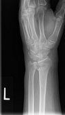 Wrist Fracture